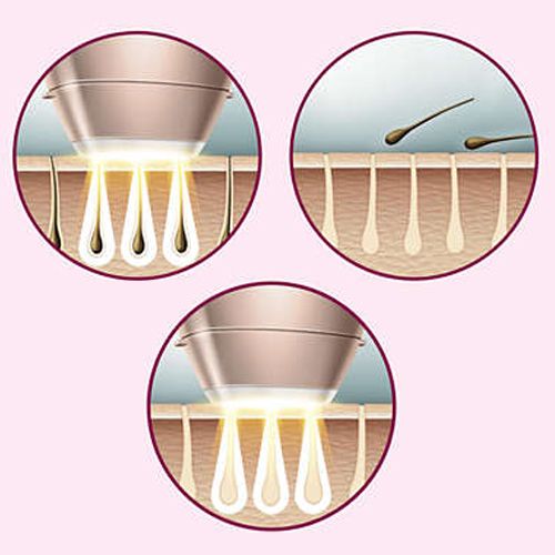 Philips Lumea 7000 Serisi SC1997/00 IPL Tüy Alma Gülkurusu Renkli 2 Başlık ve Çanta ile
